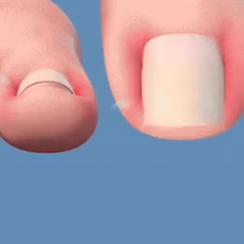 Parche corrector de uñas y hongos - IngroPatch™(Pack x50 und) – Tienda  Nihuel